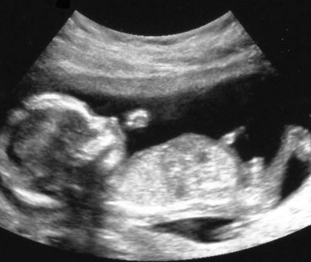 14 hafta fetus ultrason liste